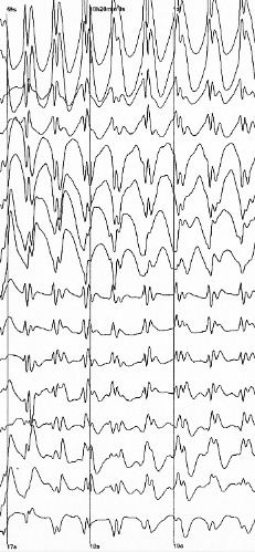 eeg eeg